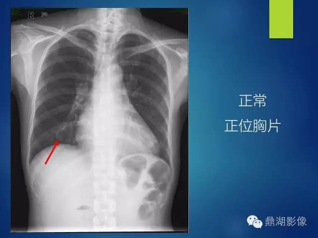 40例典型胸片