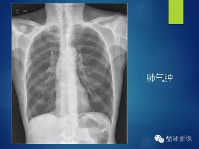 40例典型胸片