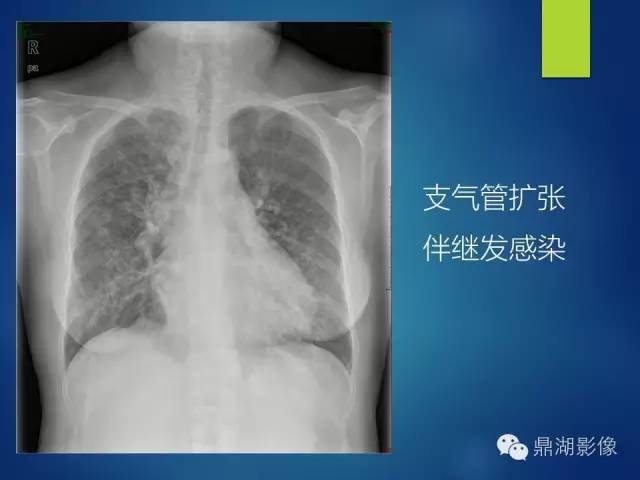 40例典型胸片