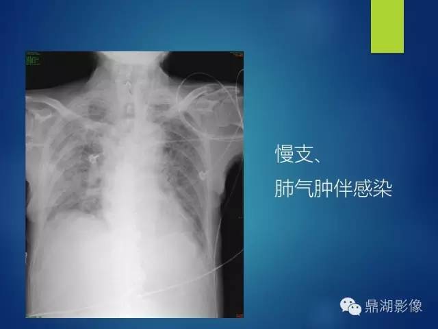 40例典型胸片