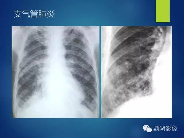 40例典型胸片