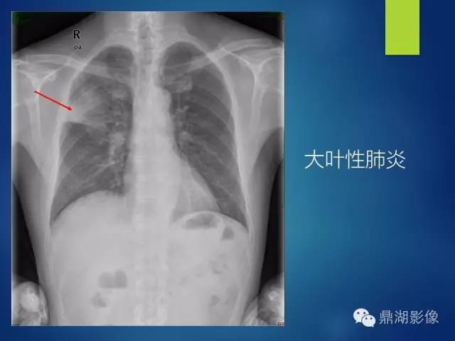 40例典型胸片