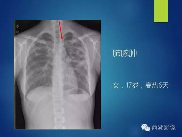 40例典型胸片