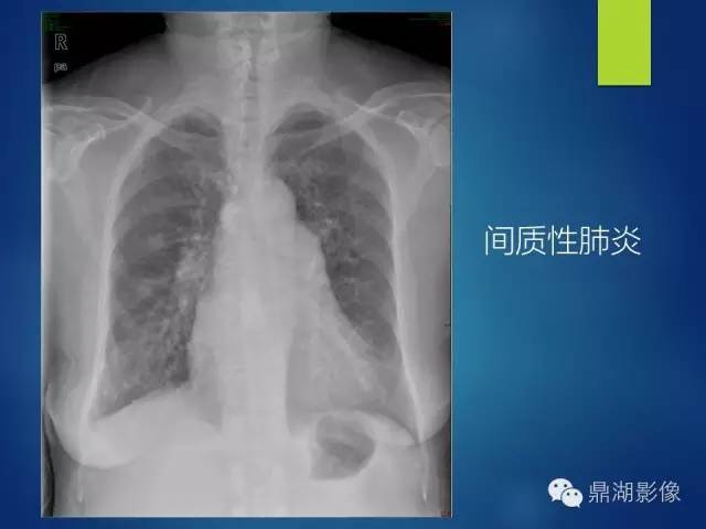 40例典型胸片