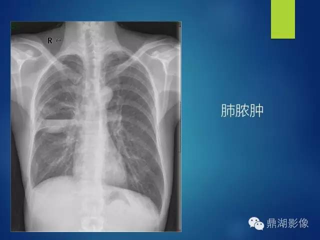 40例典型胸片