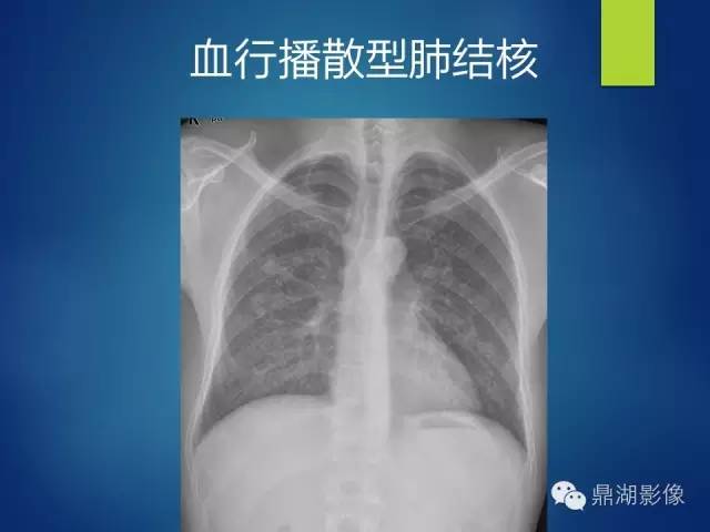 40例典型胸片