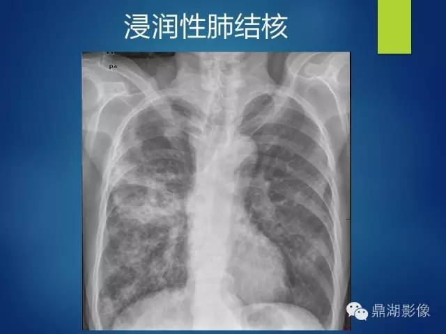 40例典型胸片