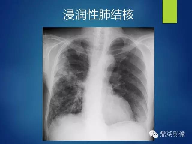 40例典型胸片