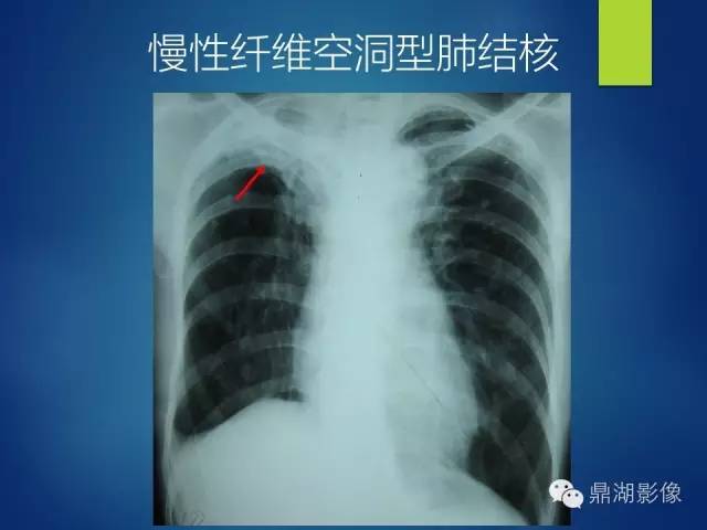 40例典型胸片