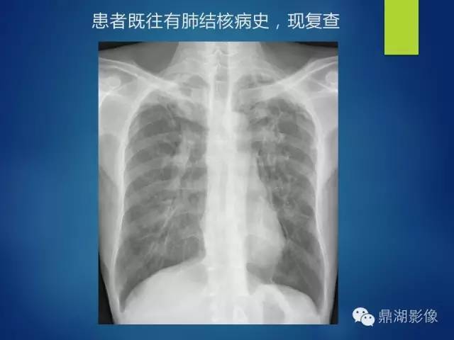 40例典型胸片