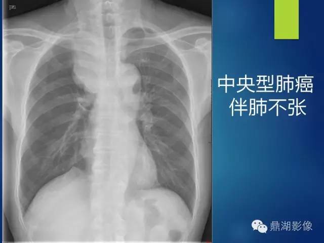 40例典型胸片