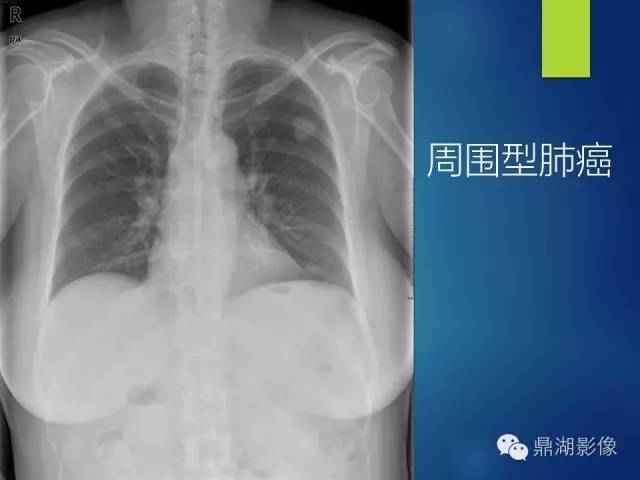 40例典型胸片