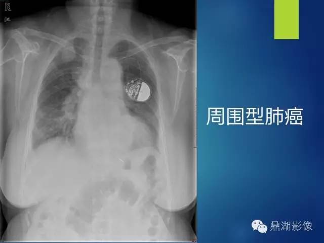 40例典型胸片
