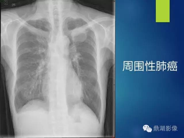 40例典型胸片