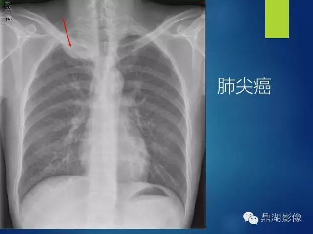 40例典型胸片