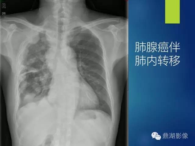 40例典型胸片