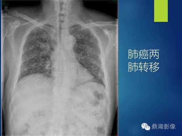 40例典型胸片