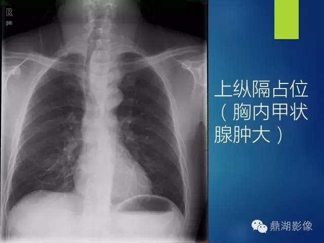 40例典型胸片