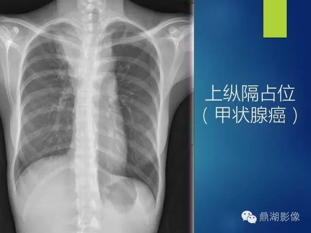 40例典型胸片