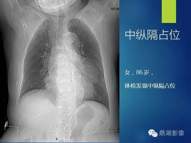 40例典型胸片