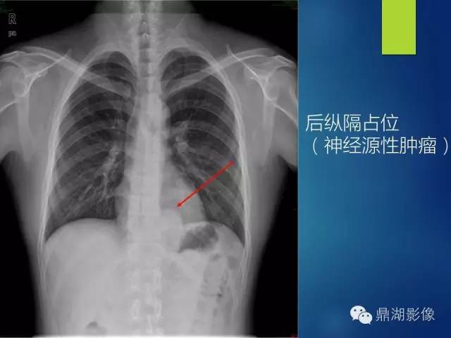 40例典型胸片