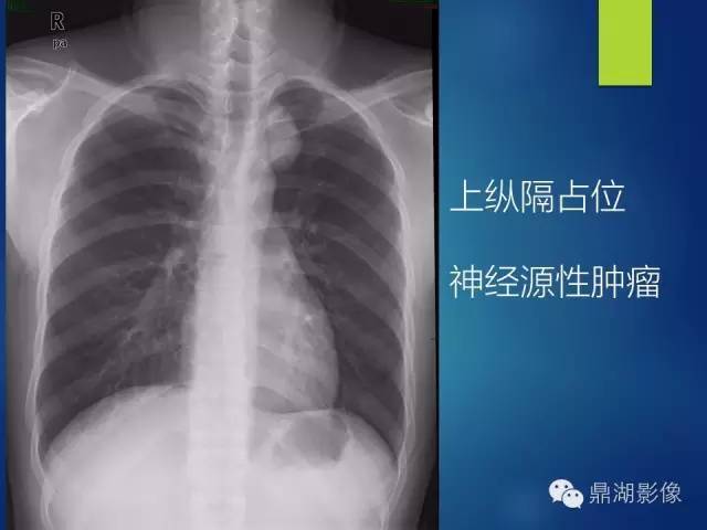 40例典型胸片