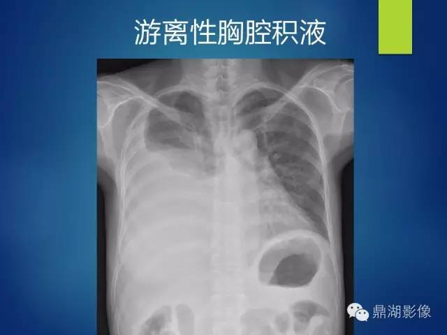 40例典型胸片