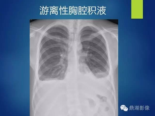 40例典型胸片