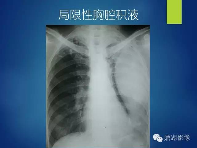 40例典型胸片