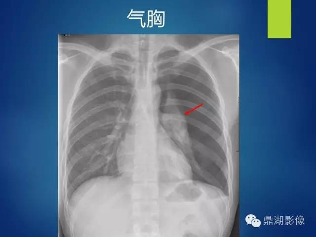 40例典型胸片