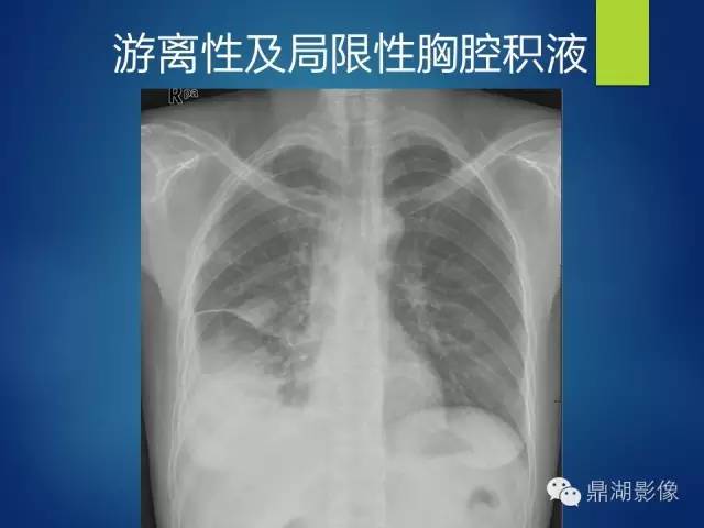 40例典型胸片