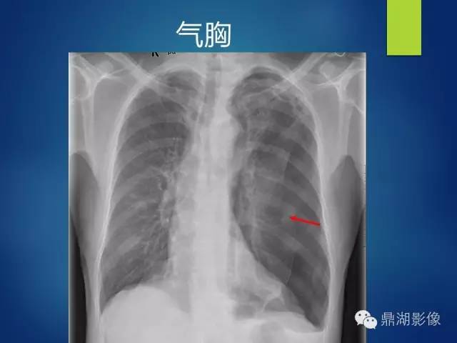 40例典型胸片