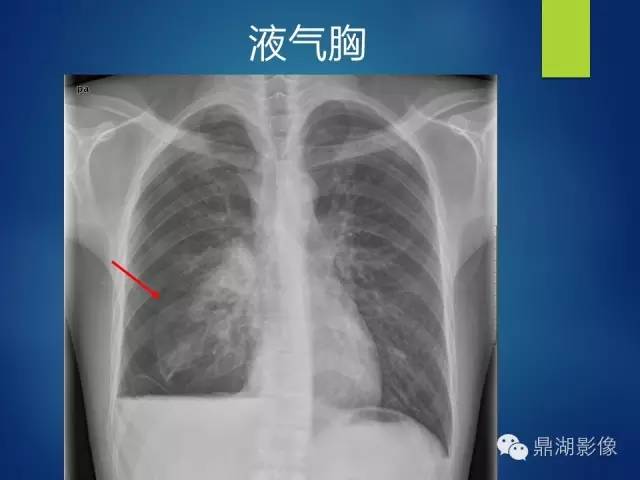 40例典型胸片
