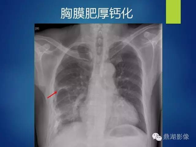 40例典型胸片