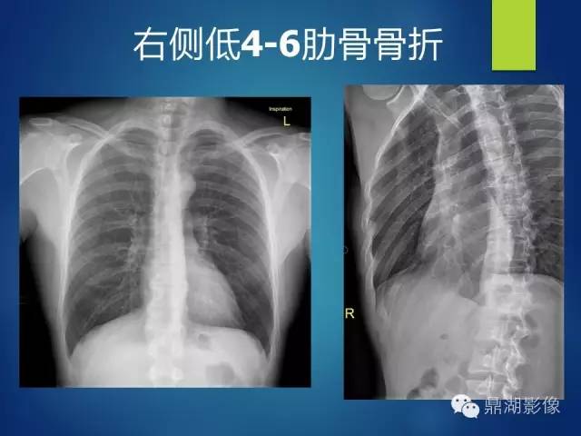 40例典型胸片