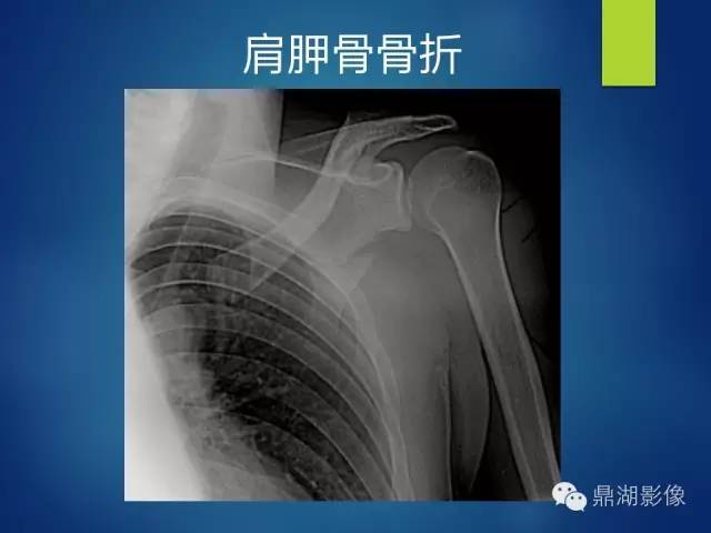 40例典型胸片