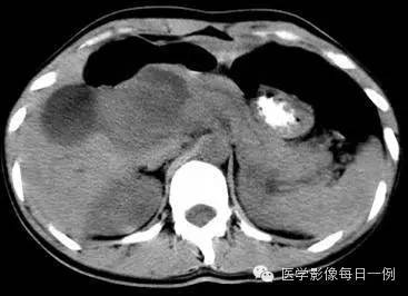 【病例】胰腺实性假乳头状瘤1例CT影像表现 【病例】胰腺实性假乳头状瘤1例CT影像表现