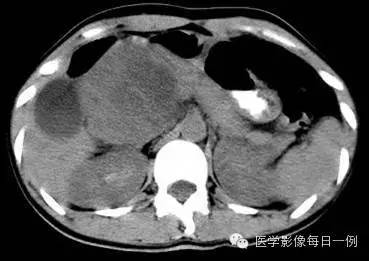 【病例】胰腺实性假乳头状瘤1例CT影像表现