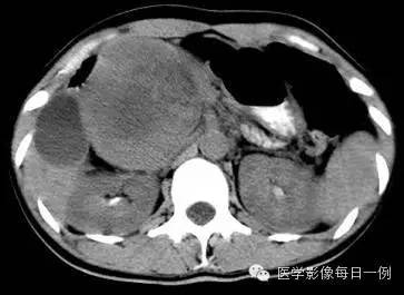 【病例】胰腺实性假乳头状瘤1例CT影像表现 【病例】胰腺实性假乳头状瘤1例CT影像表现