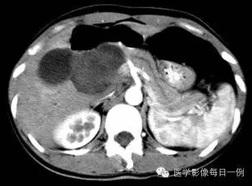 【病例】胰腺实性假乳头状瘤1例CT影像表现 【病例】胰腺实性假乳头状瘤1例CT影像表现