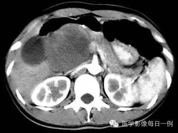 【病例】胰腺实性假乳头状瘤1例CT影像表现 【病例】胰腺实性假乳头状瘤1例CT影像表现
