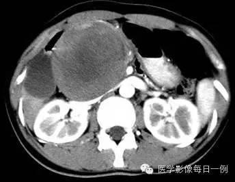 【病例】胰腺实性假乳头状瘤1例CT影像表现 【病例】胰腺实性假乳头状瘤1例CT影像表现