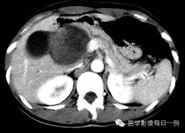 【病例】胰腺实性假乳头状瘤1例CT影像表现 【病例】胰腺实性假乳头状瘤1例CT影像表现