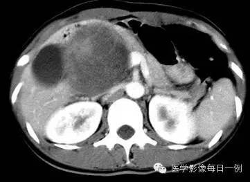【病例】胰腺实性假乳头状瘤1例CT影像表现 【病例】胰腺实性假乳头状瘤1例CT影像表现
