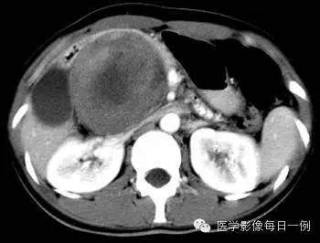 【病例】胰腺实性假乳头状瘤1例CT影像表现 【病例】胰腺实性假乳头状瘤1例CT影像表现