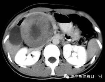 【病例】胰腺实性假乳头状瘤1例CT影像表现 【病例】胰腺实性假乳头状瘤1例CT影像表现