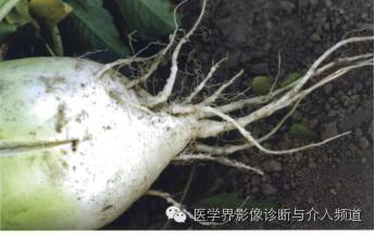 盘点：那些形象而有趣的影像学征象