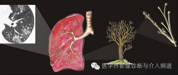 盘点：那些形象而有趣的影像学征象