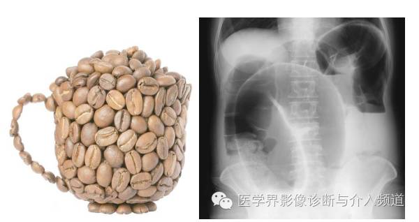 盘点：那些形象而有趣的影像学征象