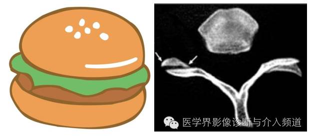 盘点：那些形象而有趣的影像学征象